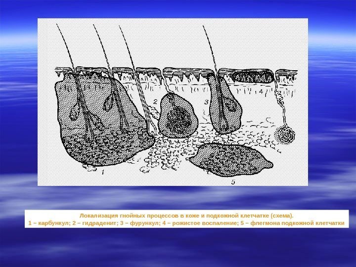 Локализация гнойных процессов в коже и подкожной клетчатке (схема). 1 – карбункул; 2 –