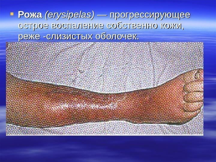  Рожа (е(е rysipelas ) — прогрессирующее острое воспаление собственно кожи,  реже -слизистых