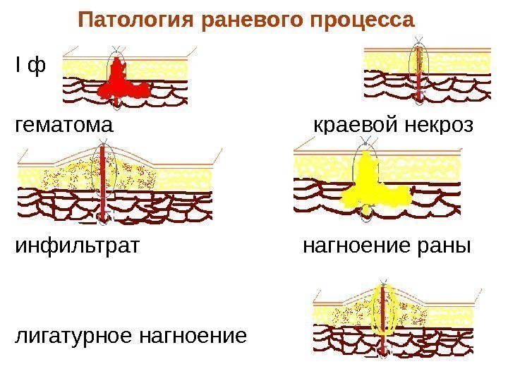 Патология раневого процесса  I ф гематома      краевой некроз