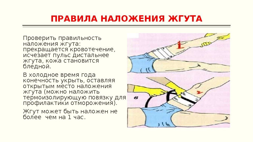 Техника наложения жгута при кровотечении