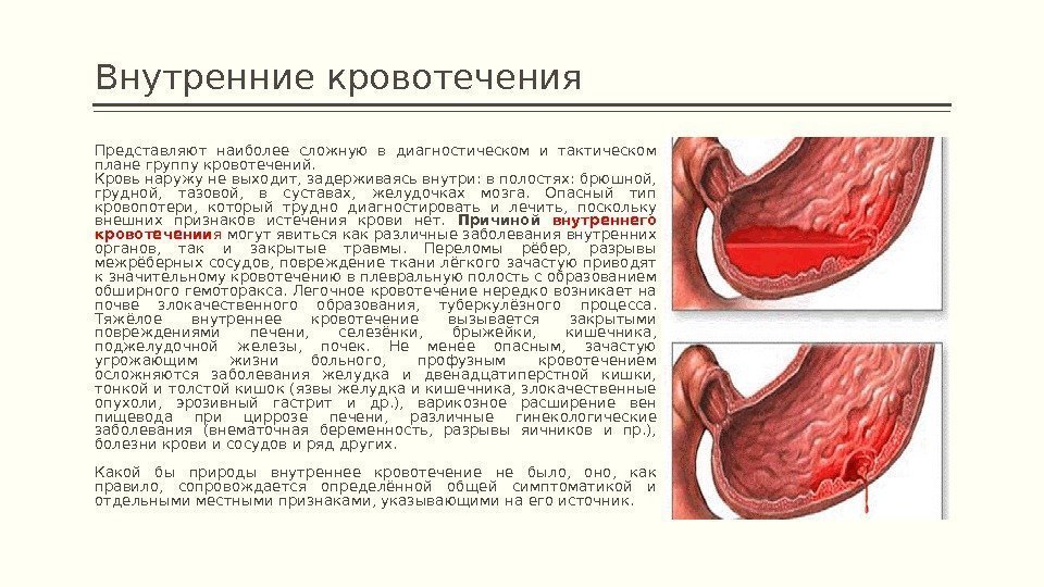 Внутренние кровотечения Представляют наиболее сложную в диагностическом и тактическом плане группу кровотечений. Кровь наружу