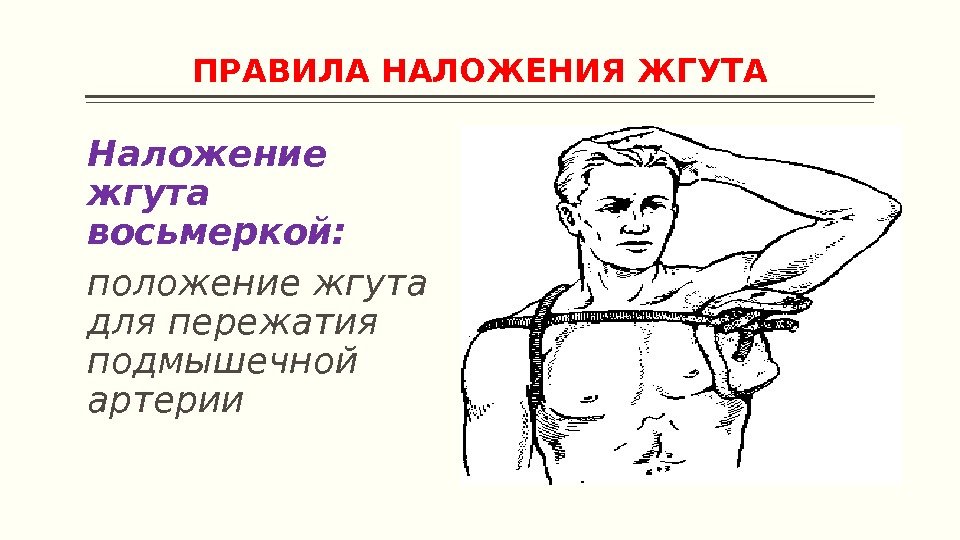 ПРАВИЛА НАЛОЖЕНИЯ ЖГУТА Наложение жгута восьмеркой: положение жгута для пережатия подмышечной артерии 