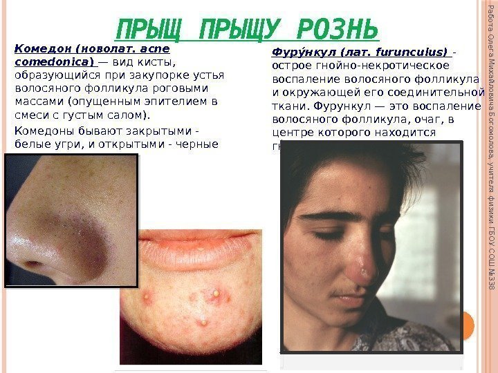 ПРЫЩУ РОЗНЬ Комедон (новолат.  acne comedonica ) — вид кисты,  образующийся при
