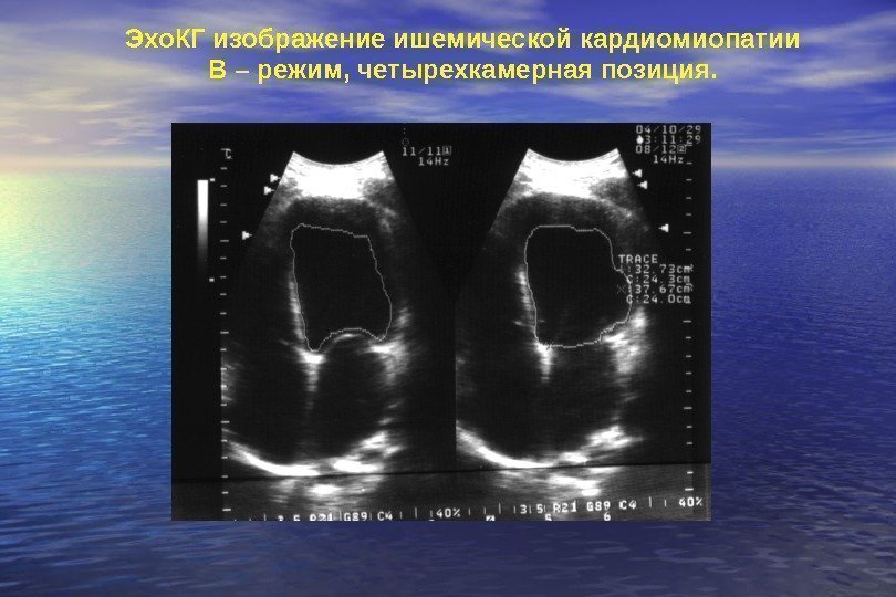   Эхо. КГ изображение ишемической кардиомиопатии В – режим, четырехкамерная позиция. 