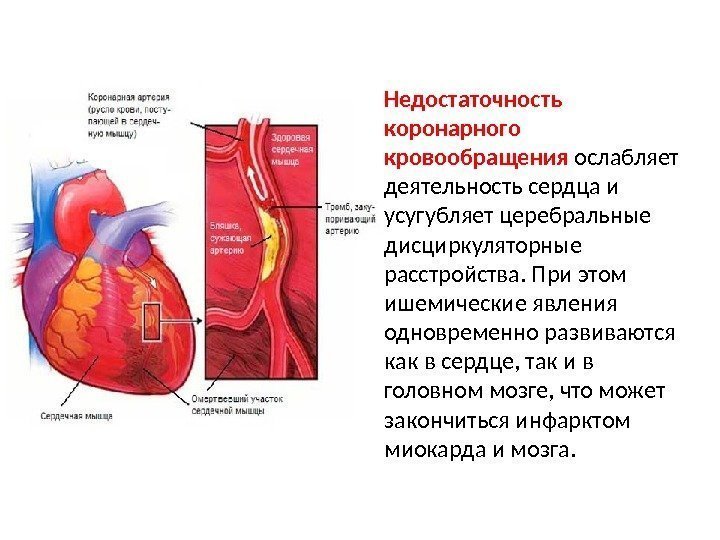 Недостаточность коронарного кровообращения ослабляет деятельность сердца и усугубляет церебральные дисциркуляторные расстройства. При этом ишемические