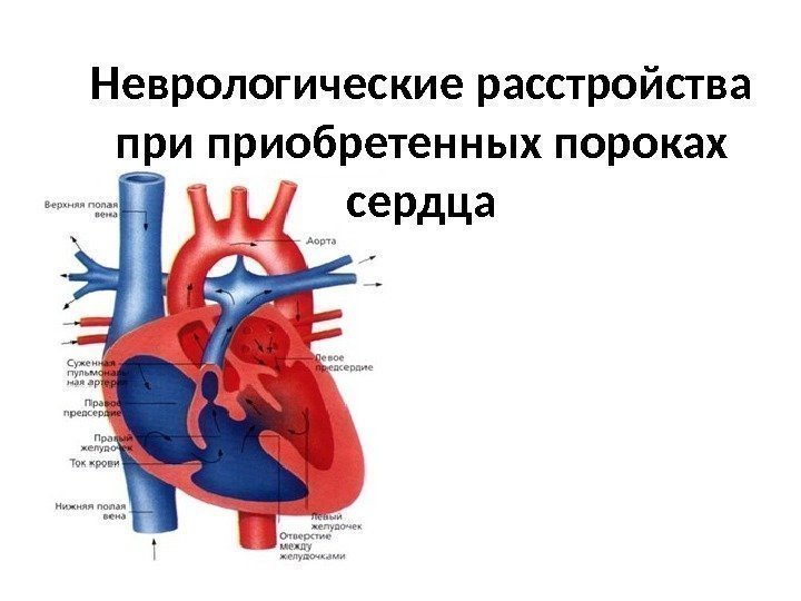 Неврологические расстройства приобретенных пороках сердца 