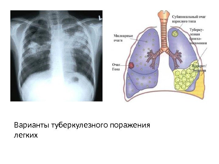 Варианты туберкулезного поражения легких 