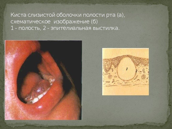 Киста слизистой оболочки полости рта (а),  схематическое изображение (б) 1 - полость, 2