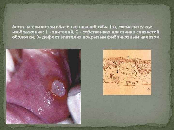 Афта на слизистой оболочке нижней губы (а), схематическое изображение: 1 - эпителий, 2 -