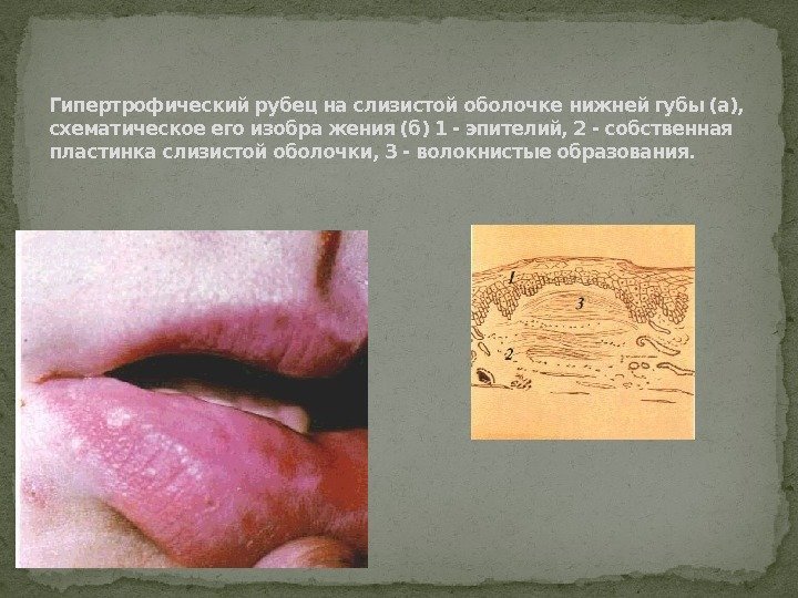 Гипертрофический рубец на слизистой оболочке нижней губы (а),  схематическое его изобра жения (б)
