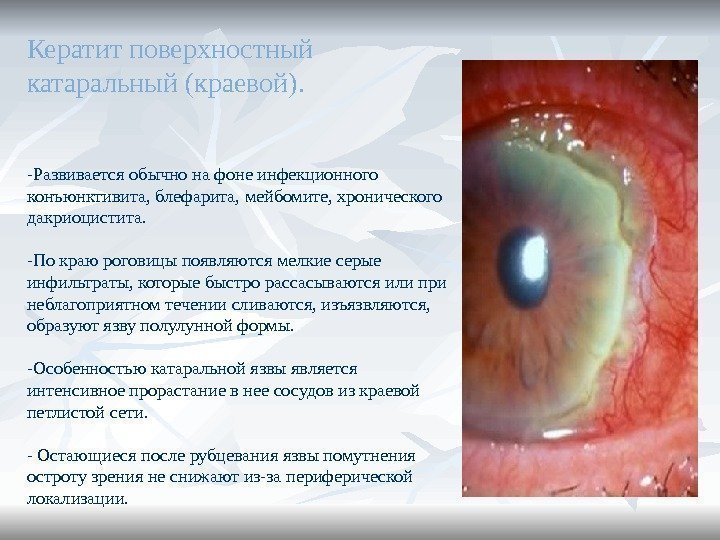 Кератит поверхностный катаральный (краевой).  -Развивается обычно на фоне инфекционного конъюнктивита, блефарита, мейбомите, хронического