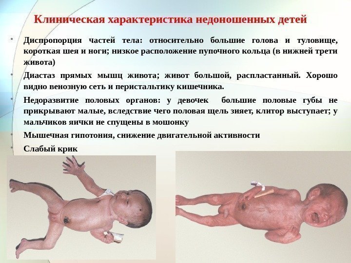 Клиническая характеристика недоношенных детей  • Диспропорция частей тела:  относительно большие голова и