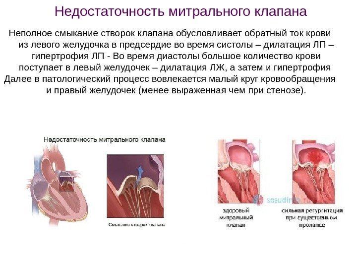 Неполное смыкание створок клапана обусловливает обратный ток крови из левого желудочка в предсердие во