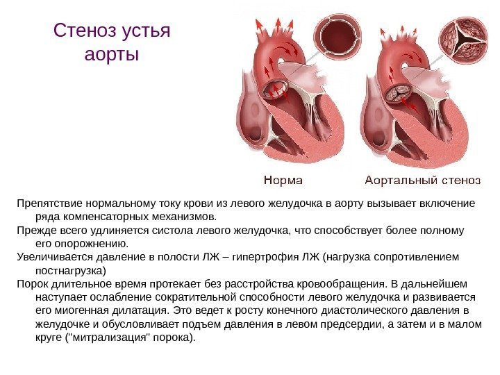 Препятствие нормальному току крови из левого желудочка в аорту вызывает включение ряда компенсаторных механизмов.