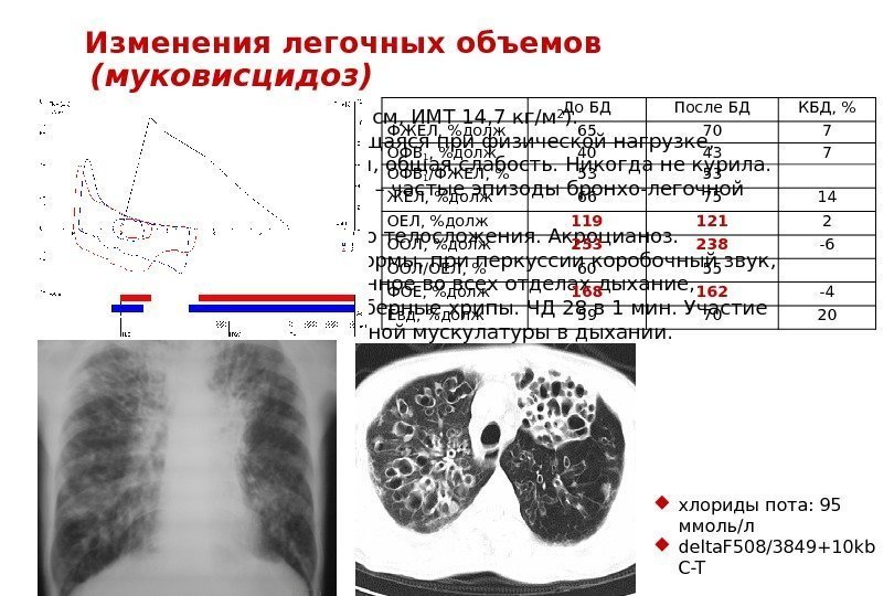 Женщина, 28 лет (рост 163 см, ИМТ 14, 7 кг/м 2 ). Одышка в