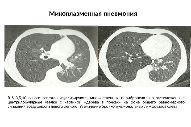 Микоплазменная пневмония В S  3, 5, 10 левого легкого визуализируются множественные перибронхиально расположенные