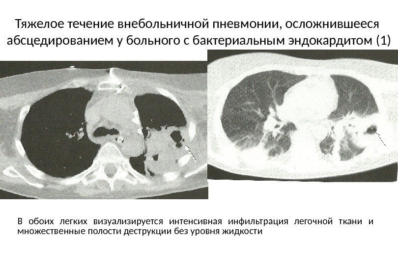 Тяжелое течение внебольничной пневмонии, осложнившееся  абсцедированием у больного с бактериальным эндокардитом (1) В
