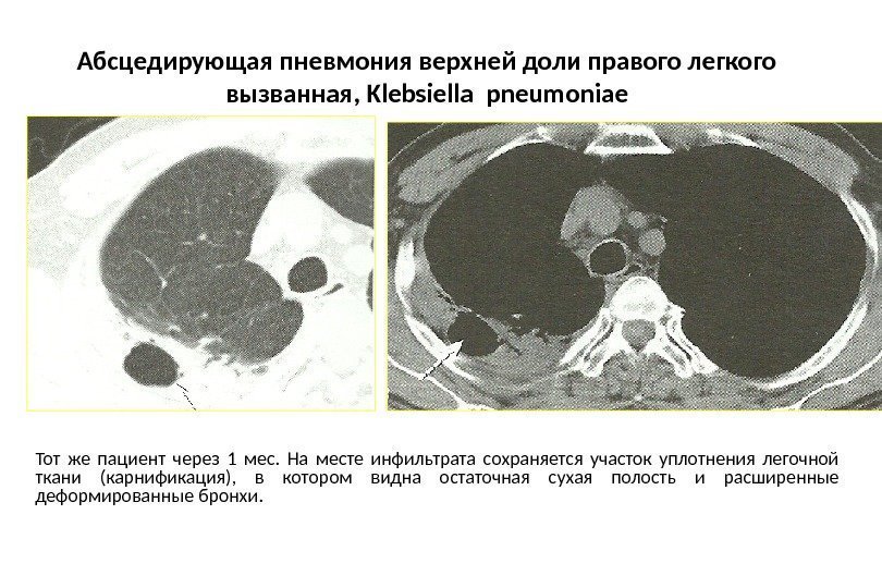 Абсцедирующая пневмония верхней доли правого легкого вызванная,  Klebsiella pneumoniae Тот же пациент через