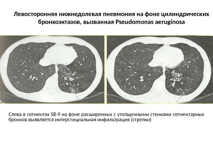 Левосторонняя нижнедолевая пневмония на фоне цилиндрических бронхоэктазов, вызванная Pseudomonas aeruginosa Слева в сегментах S
