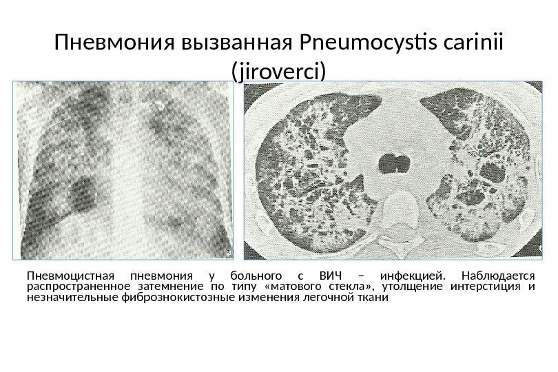 Пневмония вызванная Pneumocystis carinii (jiroverci) Пневмоцистная пневмония у больного с ВИЧ – инфекцией. 