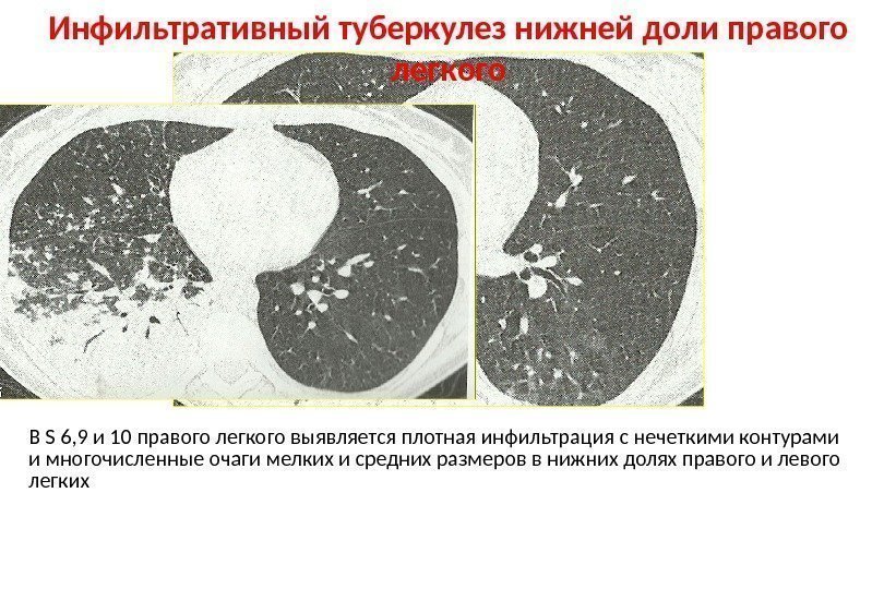 Нечеткие контуры легкого