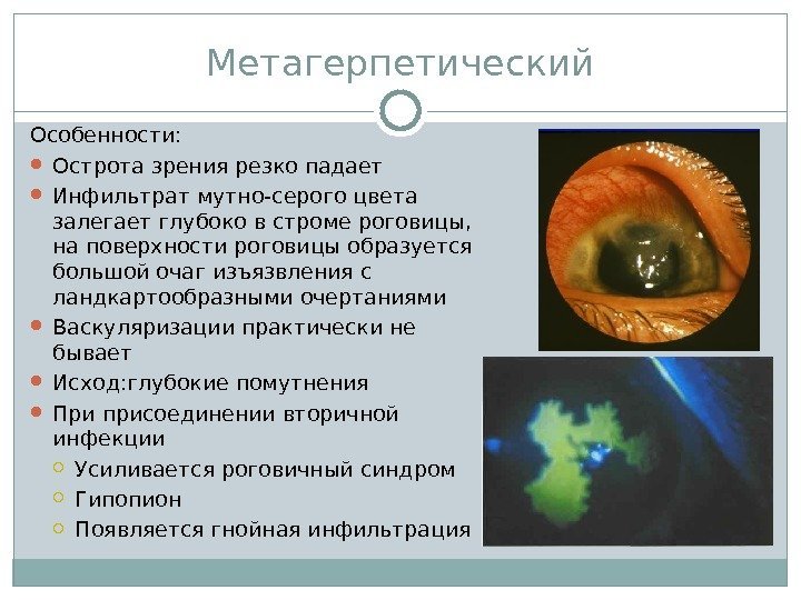 Метагерпетический Особенности:  Острота зрения резко падает Инфильтрат мутно-серого цвета залегает глубоко в строме