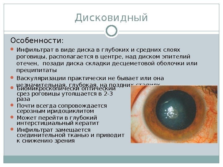 Дисковидный Особенности:  Инфильтрат в виде диска в глубоких и средних слоях роговицы, располагается