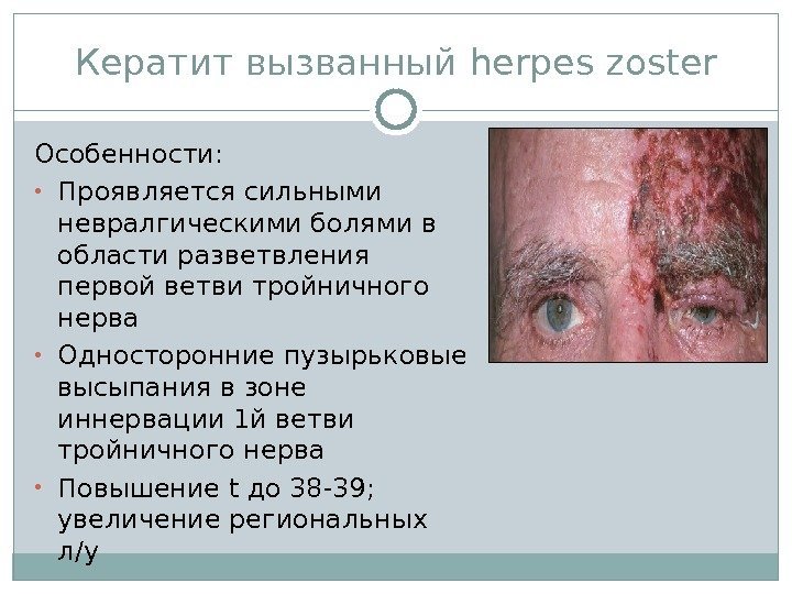 Кератит вызванный herpes zoster Особенности:  • Проявляется сильными невралгическими болями в области разветвления