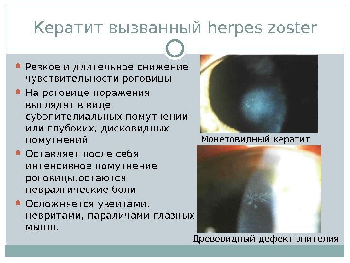 Кератит вызванный herpes zoster Резкое и длительное снижение чувствительности роговицы  На роговице поражения