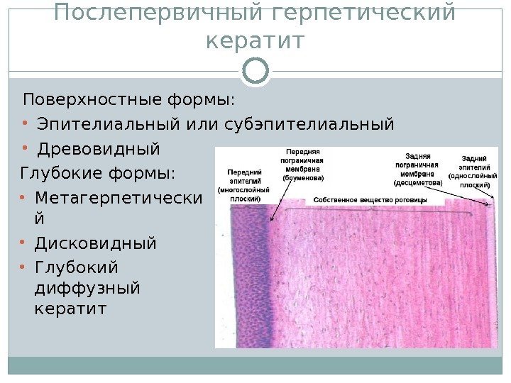 Послепервичный герпетический кератит Поверхностные формы:  • Эпителиальный или субэпителиальный • Древовидный Глубокие формы: