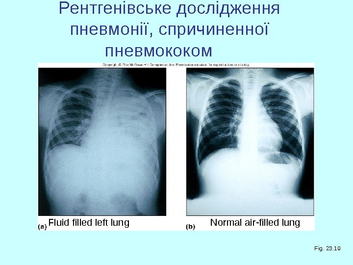   Рентгенівське дослідження пневмонії, спричиненної пневмококом  Fluid filled left lung  