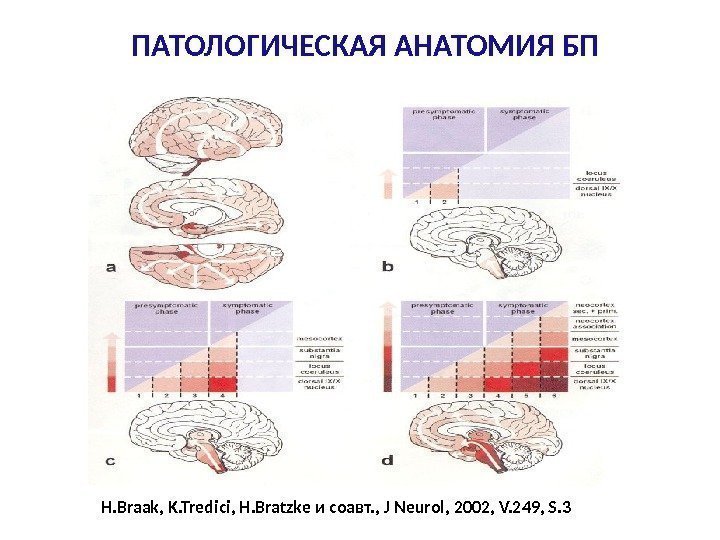 H. Braak, K. Tredici, H. Bratzke и соавт. , J Neurol, 2002, V. 249,