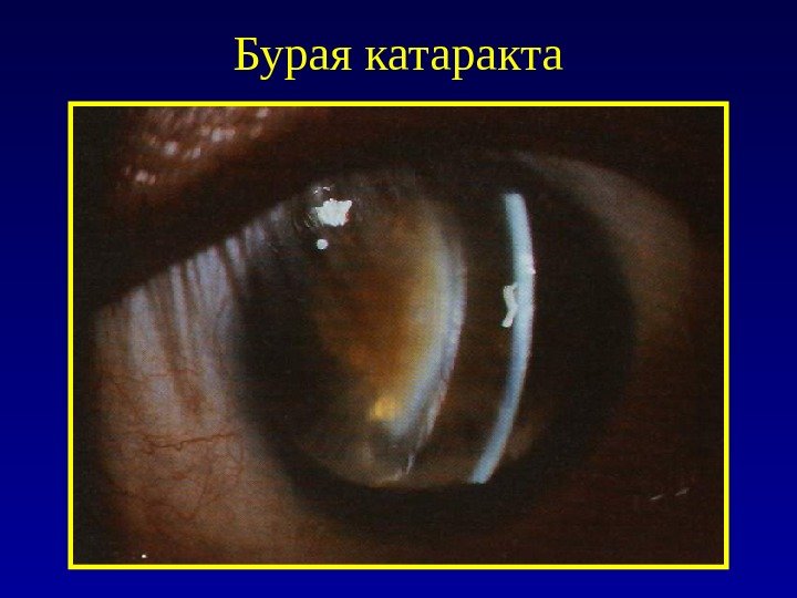 Бурая катаракта 