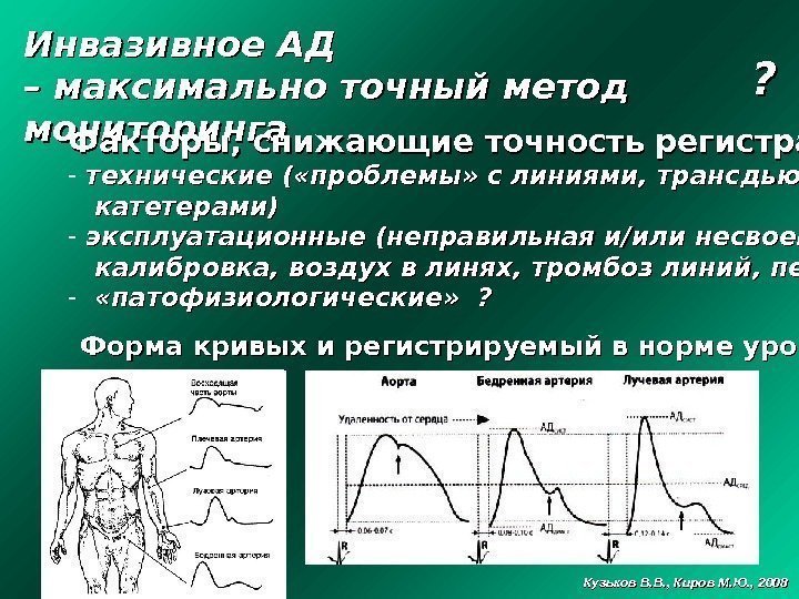 Инвазивное АД – – максимально точный метод мониторинга Факторы, снижающие точность регистрации: - 