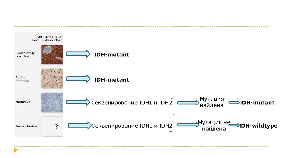 IDH-mutant Секвенирование IDH 1 и IDH 2 Мутация найдена IDH-mutant Мутация не найдена IDH-wildtype
