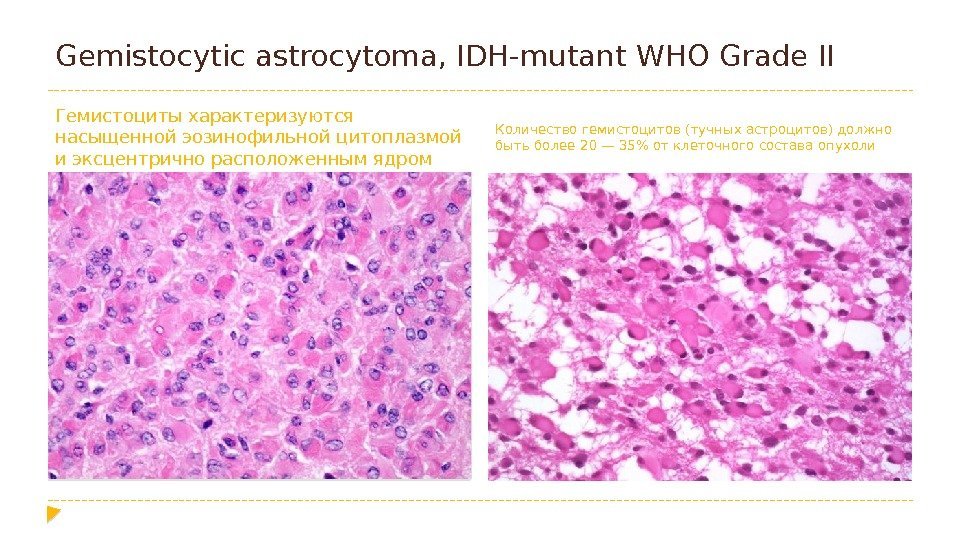 Gemistocytic astrocytoma, IDH-mutant WHO Grade II Гемистоциты характеризуются насыщенной эозинофильной цитоплазмой и эксцентрично расположенным