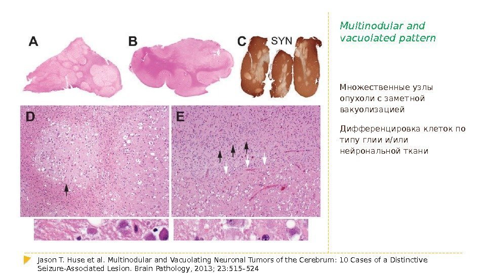 Multinodular and vacuolated pattern Множественные узлы опухоли с заметной вакуолизацией Дифференцировка клеток по типу