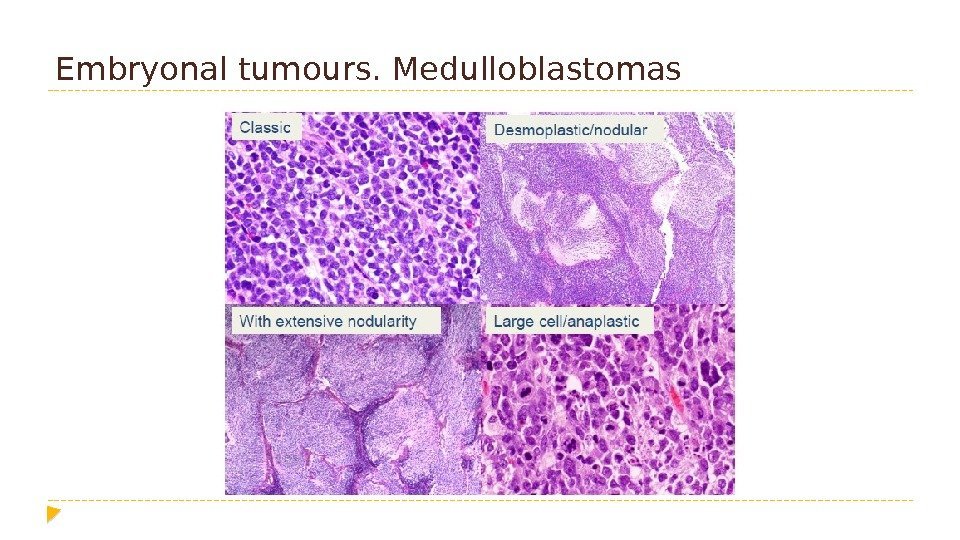 Embryonal tumours. Medulloblastomas 