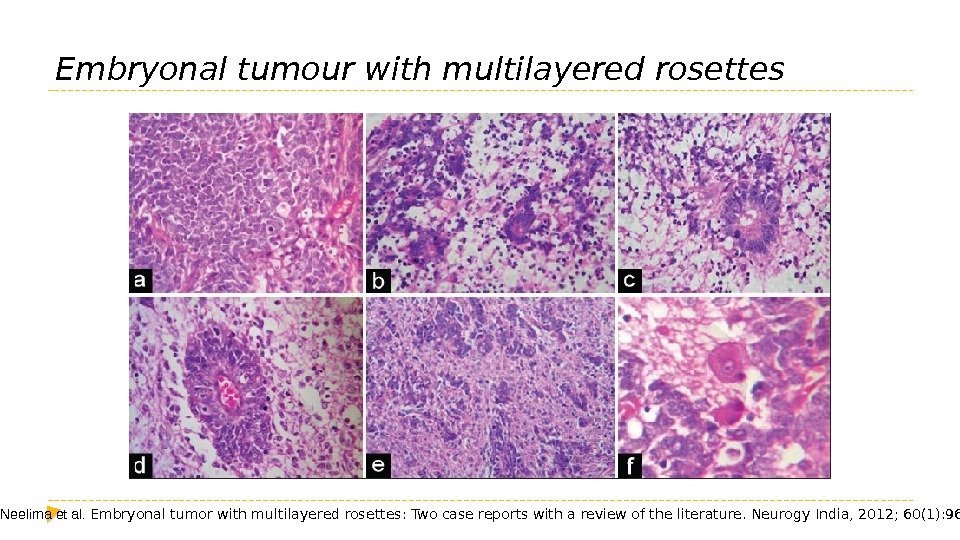 Embryonal tumour with multilayered rosettes R Neelima et al.  Embryonal tumor with multilayered