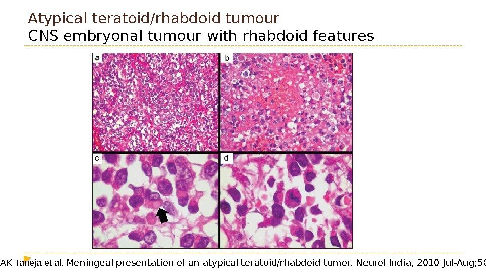 Atypical teratoid/rhabdoid tumour CNS embryonal tumour with rhabdoid features  AK Taneja et al.