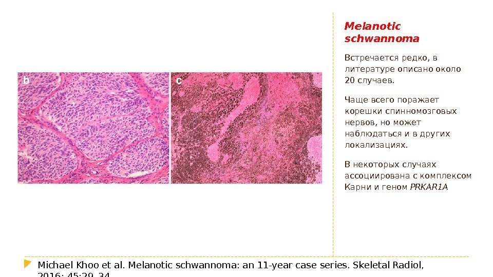 Melanotic schwannoma Встречается редко, в литературе описано около 20 случаев. Чаще всего поражает корешки