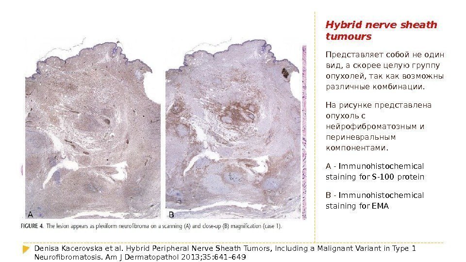Hybrid nerve sheath tumours Представляет собой не один вид, а скорее целую группу опухолей,