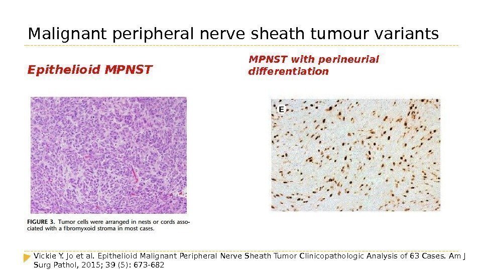 Malignant peripheral nerve sheath tumour variants Epithelioid MPNST with perineurial differentiation Vickie Y. Jo