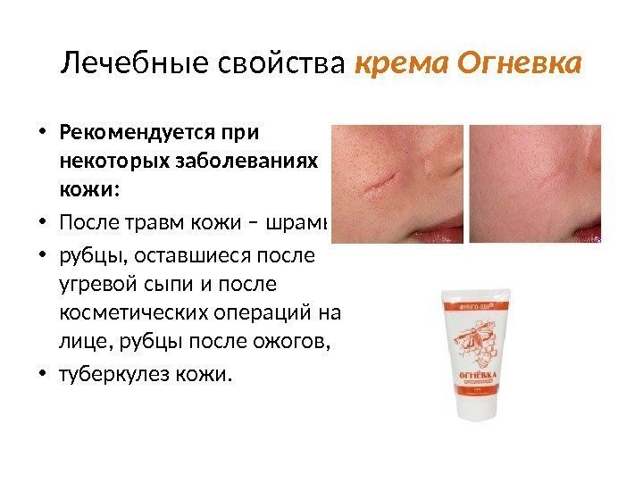 Лечебные свойства крема Огневка • Рекомендуется при некоторых заболеваниях кожи:  • После травм