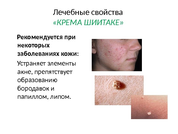 Лечебные свойства  «КРЕМА ШИИТАКЕ»   Рекомендуется при некоторых заболеваниях кожи:  Устраняет