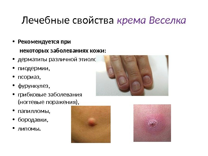 Лечебные свойства крема Веселка • Рекомендуется при  некоторых заболеваниях кожи:  • дерматиты