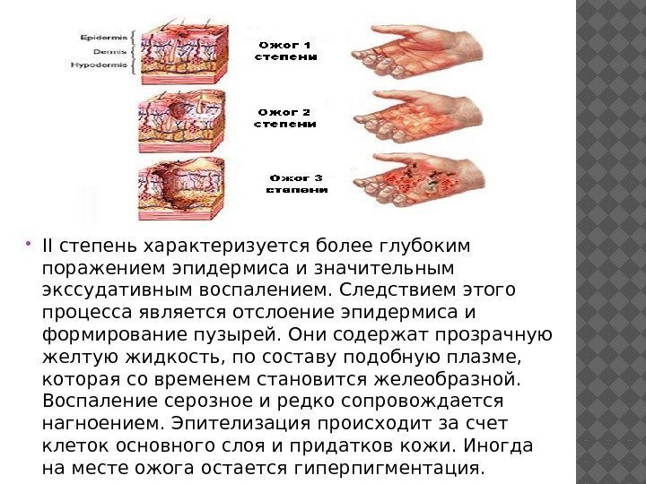  II степень характеризуется более глубоким поражением эпидермиса и значительным экссудативным воспалением. Следствием этого