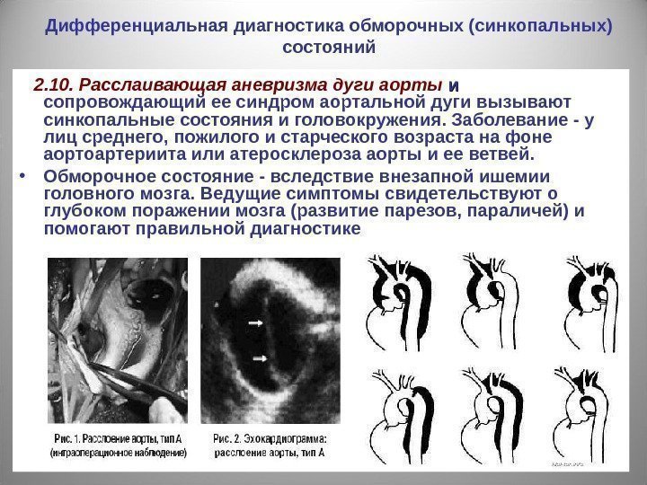 Дифференциальная диагностика обморочных (синкопальных) состояний 2. 10. Расслаивающая аневризма дуги аорты  и и