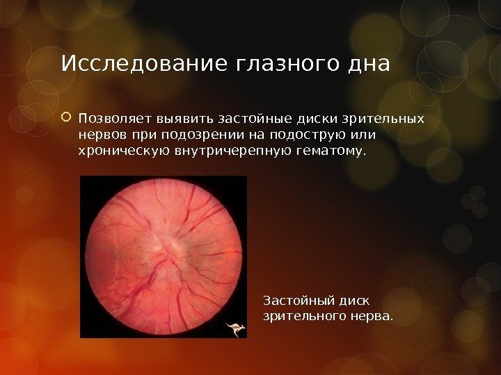 Исследование глазного дна Позволяет выявить застойные диски зрительных нервов при подозрении на подострую или