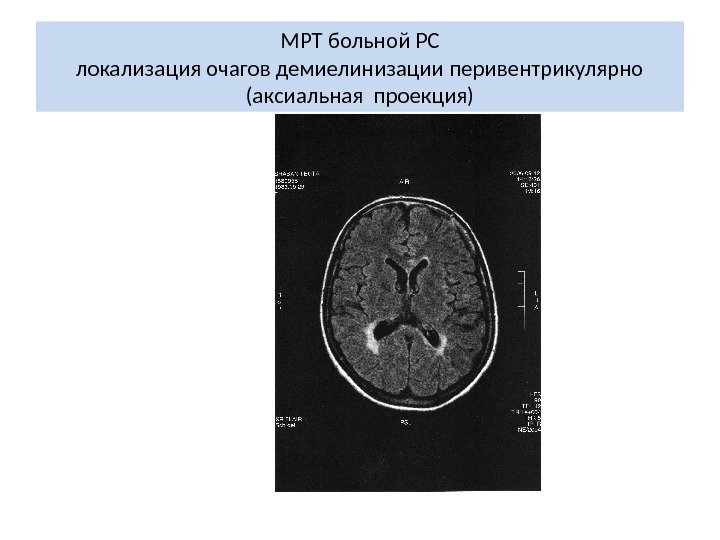 МРТ больной РС локализация очагов демиелинизации перивентрикулярно (аксиальная проекция) 